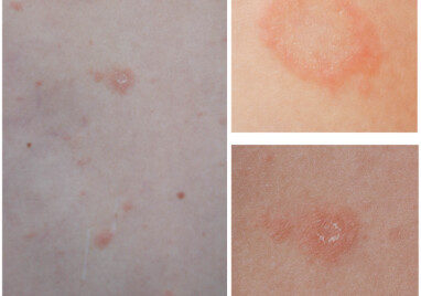 PITYRIASIS ROSEA: Godt eksempel på utslettets utseende, med innovervendt flasskrage på utslettet. Ved en soppinfeksjon ville man hatt skjelling i ytterkant av utslettet. FOTO: NTB Scanpix / Shutterstock Laksena PITYRIASIS ROSEA: Godt eksempel på utslettets utseende, med innovervendt flasskrage på utslettet. Ved en soppinfeksjon ville man hatt skjelling i ytterkant av utslettet. FOTO: NTB Scanpix / Shutterstock Laksena